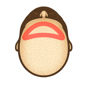 ヘアライン＋周辺（小）