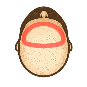 ヘアライン＋周辺（大）